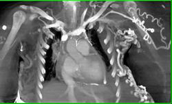 Occluded SVC With Collaterals - CTisus CT Scan