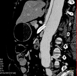 Stent in SMA With Aortic Dissection and Fem-fem Graft - CTisus CT Scan