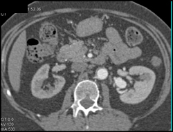 Renal Artery Aneurysm - CTisus CT Scan