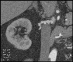 Fmd on Right and Renal Artery Aneurysm on the Left - CTisus CT Scan