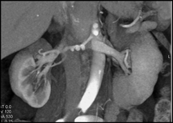 FMD - Fibromuscular Dysplasia - CTisus CT Scan