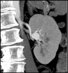 Renal Artery Aneurysm - CTisus CT Scan