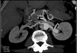 Renal Artery Aneurysm - CTisus CT Scan