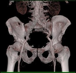 Patent Iliac Artery Stent With Multiple Imaging Tools to Show Its Patency - CTisus CT Scan