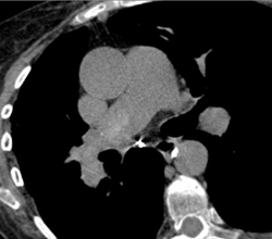 Chronic Pulmonary Embolism - CTisus CT Scan