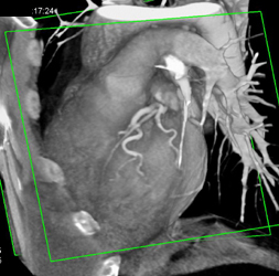 RCA Arises Off Left Cusp - CTisus CT Scan