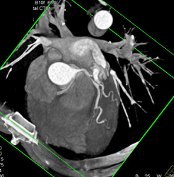 RCA Arises Off Left Cusp - CTisus CT Scan