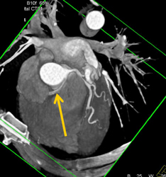 RCA Arises Off Left Cusp - CTisus CT Scan