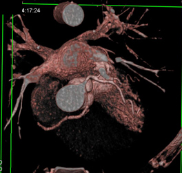 RCA Arises Off Left Cusp - CTisus CT Scan