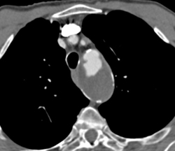 Aortic Ulcer With Aneurysm - CTisus CT Scan