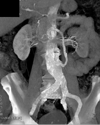 Bypass Graft to SMA - CTisus CT Scan