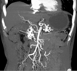 Abberant Right Hepatic Artery and Chronic Pancreatitis - CTisus CT Scan