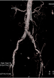 Superficial Femoral Artery (SFA) Disease on the Left - CTisus CT Scan