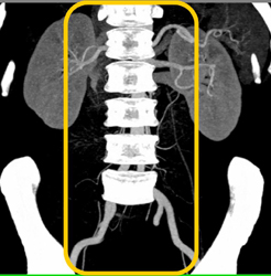 Advantages of VRT Vs MIP When No Editing Is Used Is Shown Here - CTisus CT Scan