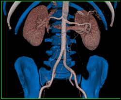 VRT With Editing - CTisus CT Scan