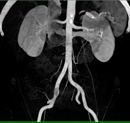 Nice Retroaortic Renal Vein - CTisus CT Scan