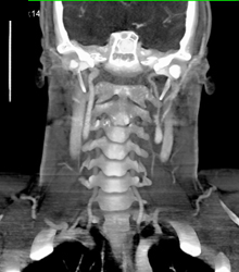 Trauma to Left Internal Carotid Artery - CTisus CT Scan