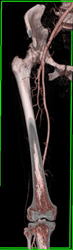 Superficial Femoral Artery (SFA) With CTA - CTisus CT Scan