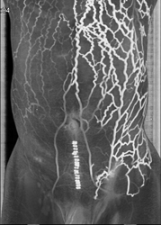 Collaterals Over Abdominal Wall - CTisus CT Scan