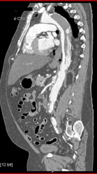 Type B Dissection - CTisus CT Scan