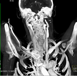 Loeys-Dietz With Ectatic Carotid Artery - CTisus CT Scan