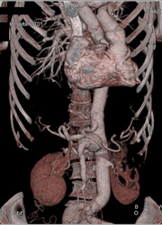 Loeys-Dietz With SMA Aneurysm and IMA Aneurysm - CTisus CT Scan