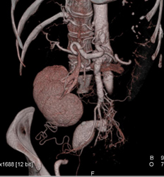 Transplant Kidney RLQ - CTisus CT Scan