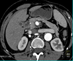 Infarct Left Kidney - CTisus CT Scan