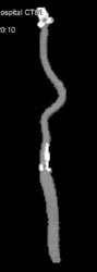 Vessel Tracking of Carotid Artery - CTisus CT Scan