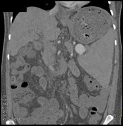 Splenic Artery Aneurysm - CTisus CT Scan