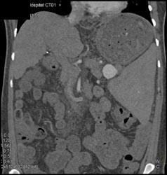 Splenic Artery Aneurysm - CTisus CT Scan