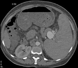 Splenic Artery Aneurysm - CTisus CT Scan