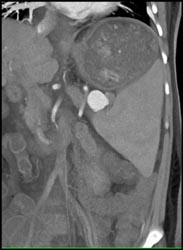 Splenic Artery Aneurysm - CTisus CT Scan