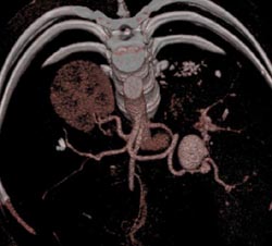 Splenic Artery Aneurysm - CTisus CT Scan