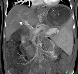 Splenic Artery Aneurysm - CTisus CT Scan