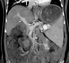 Splenic Artery Aneurysm - CTisus CT Scan