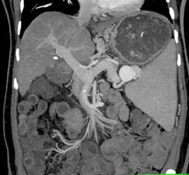 Splenic Artery Aneurysm - CTisus CT Scan