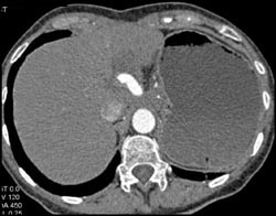 Hepatic Artery Aneurysm - CTisus CT Scan