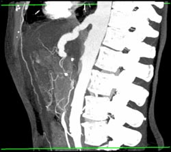 Hepatic Artery Aneurysm - CTisus CT Scan