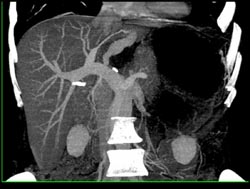 Hepatic Artery Aneurysm - CTisus CT Scan