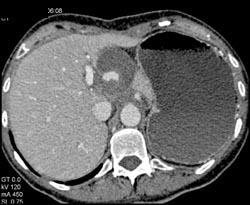 Hepatic Artery Aneurysm - CTisus CT Scan