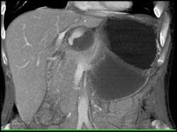 Hepatic Artery Aneurysm - CTisus CT Scan