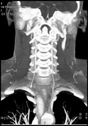 Vertebral Arteries - CTisus CT Scan