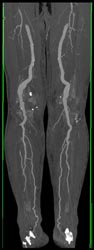 Popliteal Artery Aneurysms - CTisus CT Scan