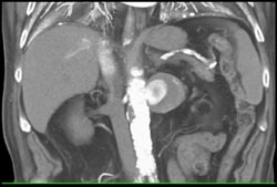 Renal Artery Aneurysm - CTisus CT Scan