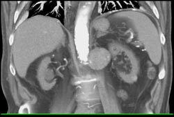 Renal Artery Aneurysm - CTisus CT Scan