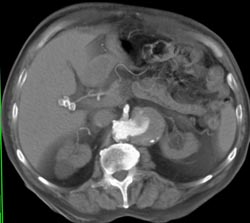 Renal Artery Aneurysm - CTisus CT Scan