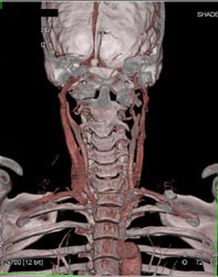 Patent Carotid Artery - CTisus CT Scan