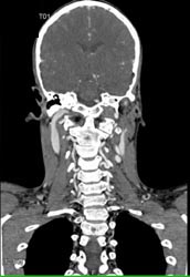 Ectatic Carotids in Loeys-Dietz - CTisus CT Scan