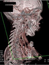 Base of Skull - CTisus CT Scan